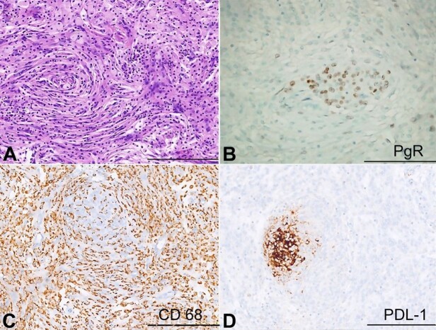 Lymphoplasmacyte-rich meningioma with hematologic signs and PD-L1 over-expression.