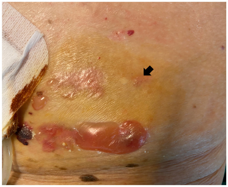 Blisters and Milia around the Peritoneal Dialysis Catheter: A Case of Localized Bullous Pemphigoid.