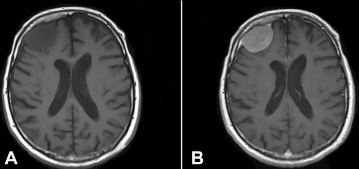 Lymphoplasmacyte-rich meningioma with hematologic signs and PD-L1 over-expression.