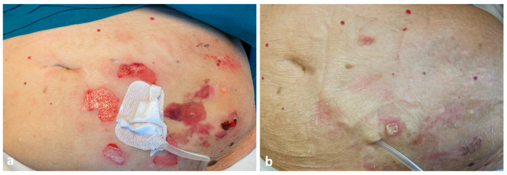 Blisters and Milia around the Peritoneal Dialysis Catheter: A Case of Localized Bullous Pemphigoid.