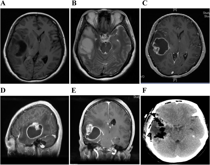 Primary gliosarcoma with widespread extracranial metastases-spatiotemporal morphological variation.