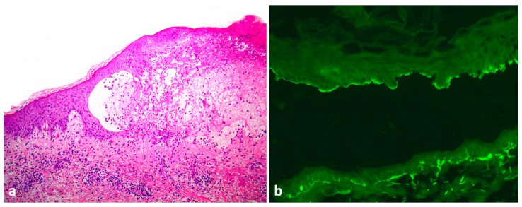 Blisters and Milia around the Peritoneal Dialysis Catheter: A Case of Localized Bullous Pemphigoid.