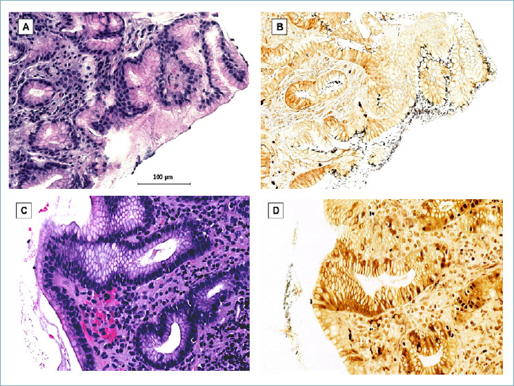 Use of digital pathology and artificial intelligence for the diagnosis of Helicobacter pylori in gastric biopsies.