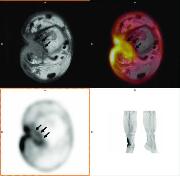 Diagnostic value of hybrid FDG-PET/MR imaging of chronic osteomyelitis.