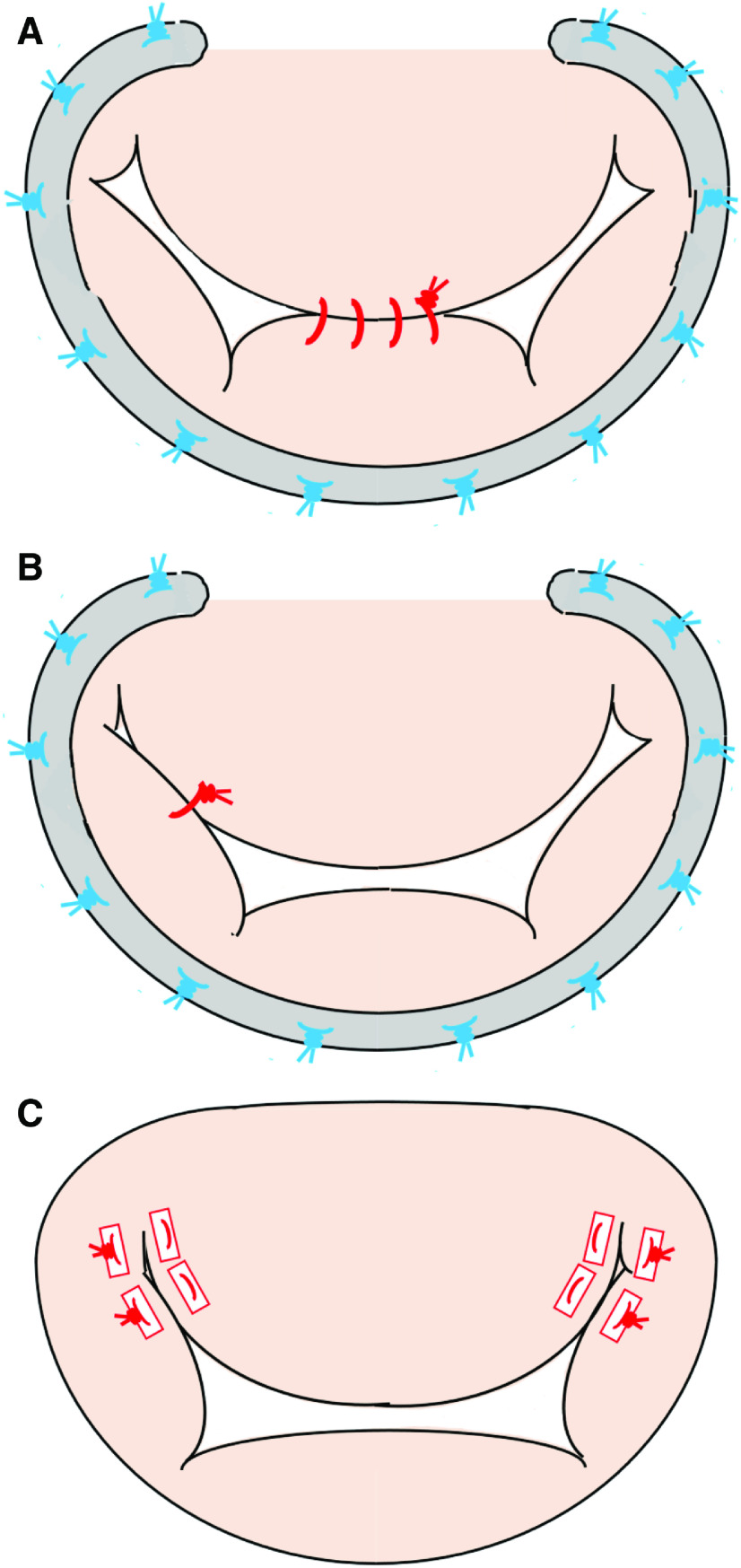 Surgical Management for Systolic Anterior Motion (SAM) of the Mitral Valve in Obstructive Hypertrophic Myopathy.