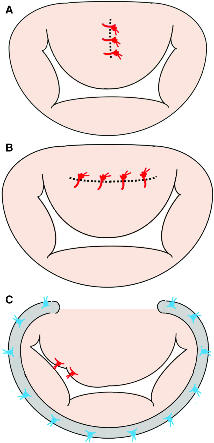 Surgical Management for Systolic Anterior Motion (SAM) of the Mitral Valve in Obstructive Hypertrophic Myopathy.