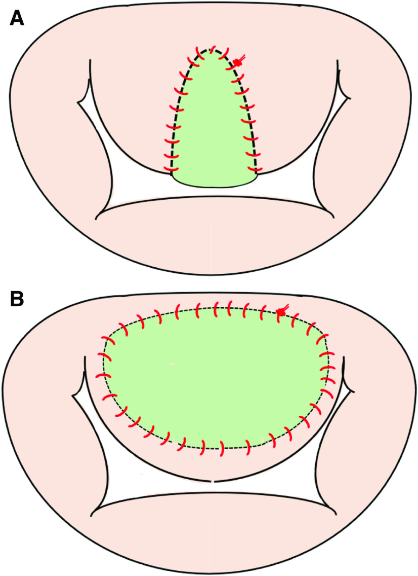 Surgical Management for Systolic Anterior Motion (SAM) of the Mitral Valve in Obstructive Hypertrophic Myopathy.