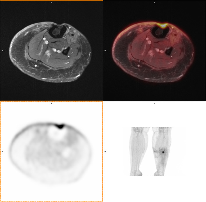 Diagnostic value of hybrid FDG-PET/MR imaging of chronic osteomyelitis.