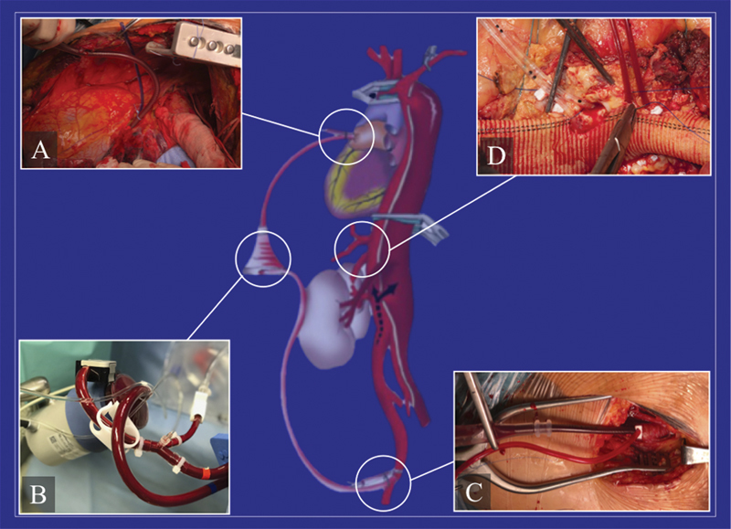 Spinal Cord Ischemia in Open and Endovascular Aortic Repair.