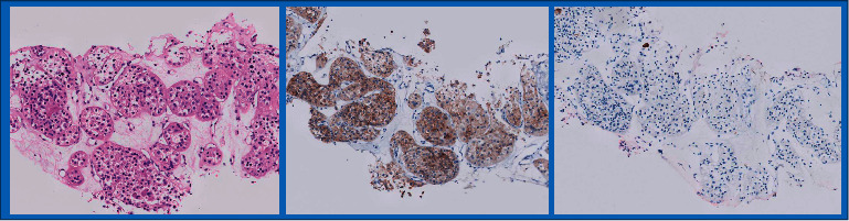 Diagnosing Oncocytoma by Core Needle Biopsy: A Single-Center Experience.