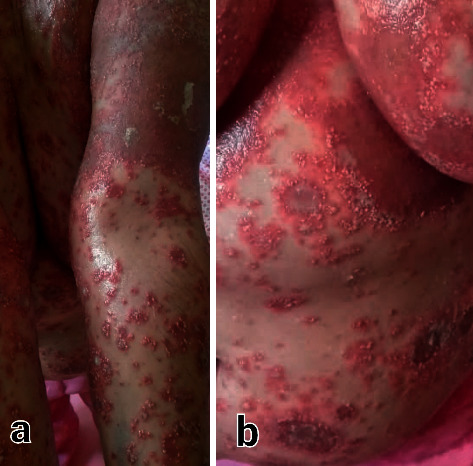 Acute Generalized Exanthematous Pustulosis following SARS-CoV-2 Virus: Remdesivir as a Suspected Culprit.