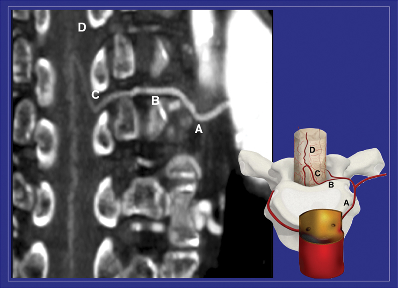 Spinal Cord Ischemia in Open and Endovascular Aortic Repair.