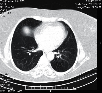 Acute Generalized Exanthematous Pustulosis following SARS-CoV-2 Virus: Remdesivir as a Suspected Culprit.