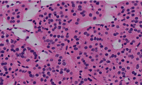 Diagnosing Oncocytoma by Core Needle Biopsy: A Single-Center Experience.