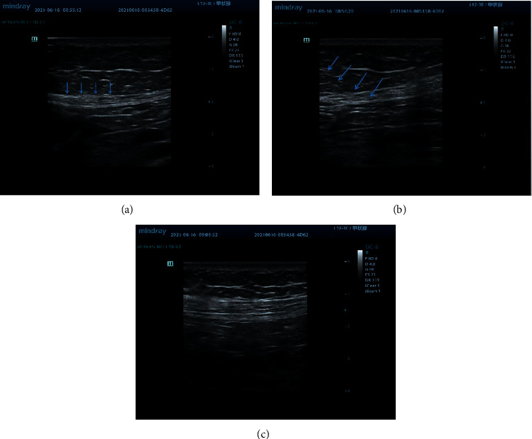 Ultrasound-Guided Dry Needling for Trigger Point Inactivation in the Treatment of Postherpetic Neuralgia Mixed with Myofascial Pain Syndrome: A Prospective and Controlled Clinical Study.