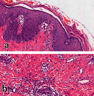 Acute Generalized Exanthematous Pustulosis following SARS-CoV-2 Virus: Remdesivir as a Suspected Culprit.