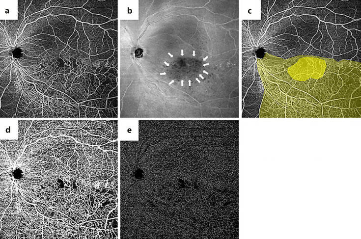 Microvascular Changes in the Cystic Lesion of Branch Retinal Vein Occlusion Imaged by Swept-Source Optical Coherence Tomography Angiography.