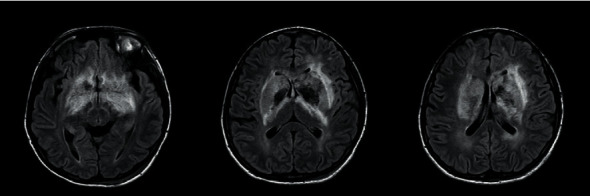 A Case of Poisoning with <i>Abrus precatarius</i> Complicated with Bilateral Basal Ganglia Haemorrhage.
