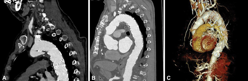 Type 1 Endoleak: Management following Thoracic Endovascular Aortic Repair.