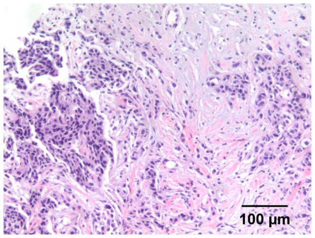 Breast Metaplastic Carcinoma With Osteosarcomatous Differentiation: A Case Report and literature Review.