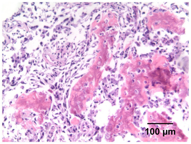 Breast Metaplastic Carcinoma With Osteosarcomatous Differentiation: A Case Report and literature Review.