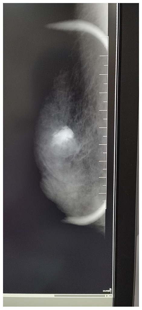Breast Metaplastic Carcinoma With Osteosarcomatous Differentiation: A Case Report and literature Review.