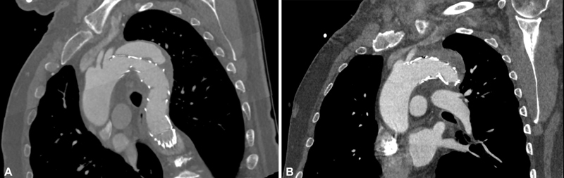 Type 1 Endoleak: Management following Thoracic Endovascular Aortic Repair.