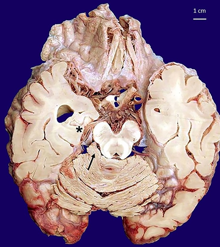 Sudden death associated with lipoma of the cerebellopontine angle.