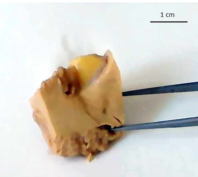 Sudden death associated with lipoma of the cerebellopontine angle.