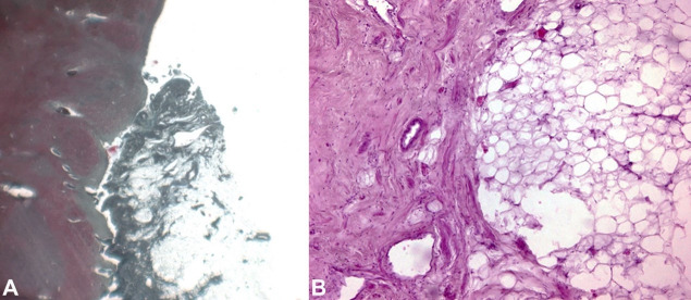 Sudden death associated with lipoma of the cerebellopontine angle.