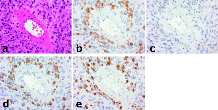 Morphologic Analysis of M2 Macrophage in Glioblastoma: Involvement of Macrophage Extracellular Traps (METs).