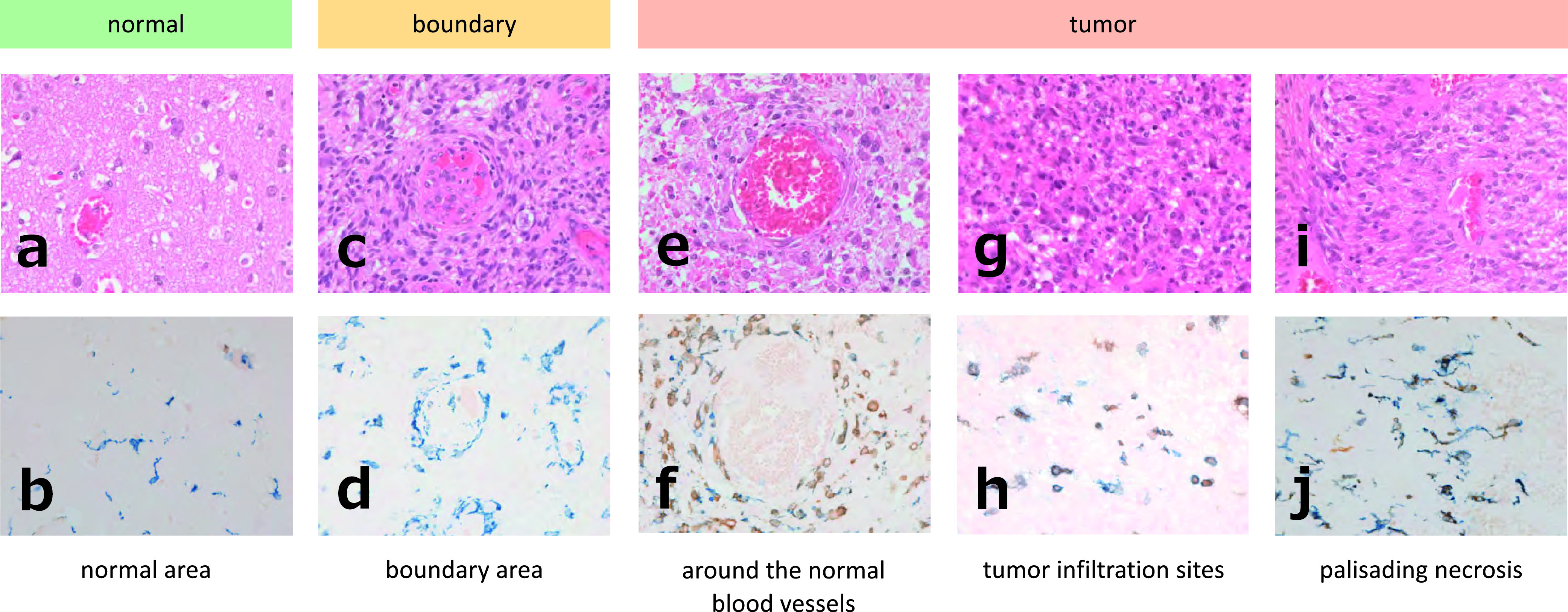 Morphologic Analysis of M2 Macrophage in Glioblastoma: Involvement of Macrophage Extracellular Traps (METs).