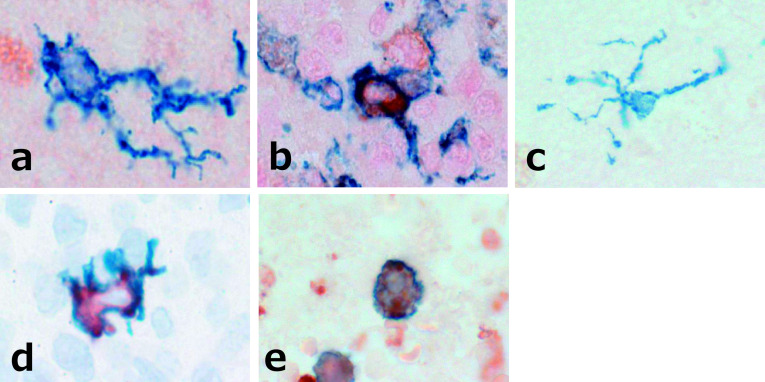 Morphologic Analysis of M2 Macrophage in Glioblastoma: Involvement of Macrophage Extracellular Traps (METs).