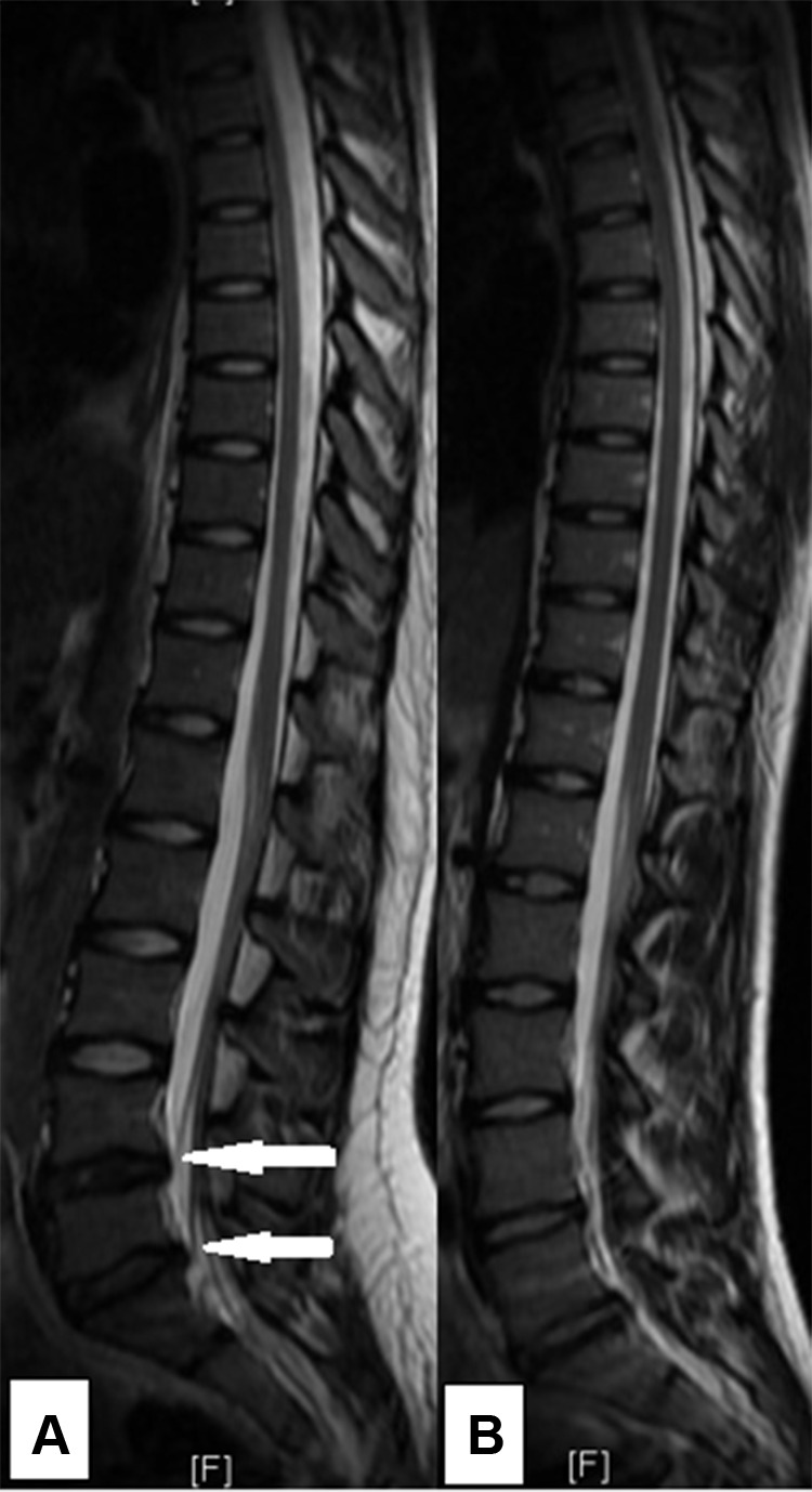No Significant Change in MRI Abnormalities or Back Pain Prevalence in the Thoraco-Lumbar Spine of Young Elite Skiers Over a 2-Year Follow-Up.