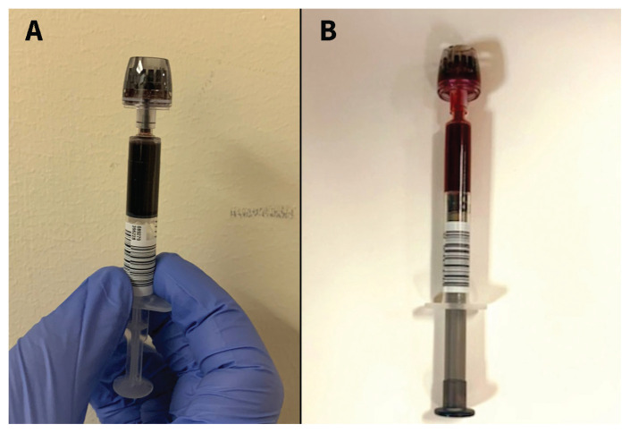 Methemoglobinemia caused by sodium nitrite overdose.