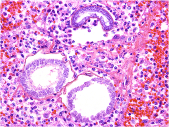 Educational Case: Coccidioidomycosis