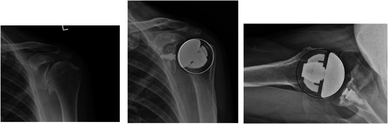 Anatomic and Reverse Stemless Shoulder Arthroplasty: Functional and Radiological Evaluation.