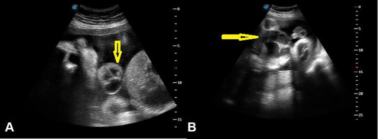 Pentalogy of Cantrell Associated with Ectopia Cordis: A Case Report.