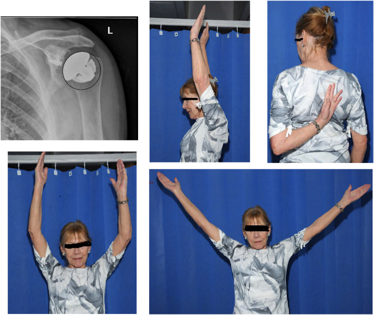 Anatomic and Reverse Stemless Shoulder Arthroplasty: Functional and Radiological Evaluation.