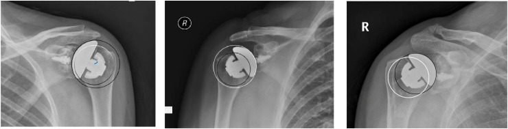 Anatomic and Reverse Stemless Shoulder Arthroplasty: Functional and Radiological Evaluation.