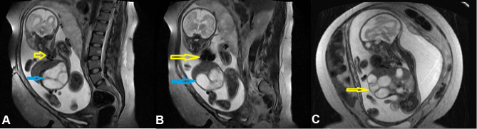 Pentalogy of Cantrell Associated with Ectopia Cordis: A Case Report.