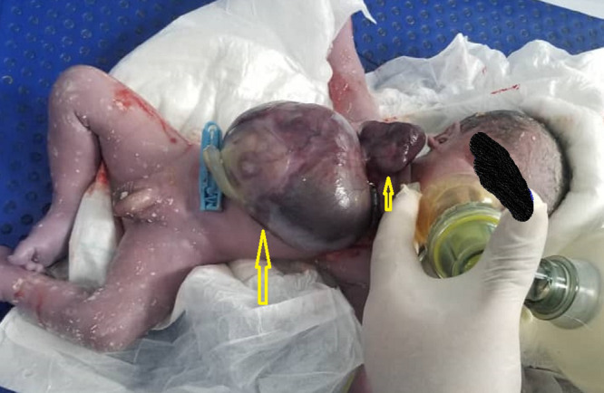 Pentalogy of Cantrell Associated with Ectopia Cordis: A Case Report.