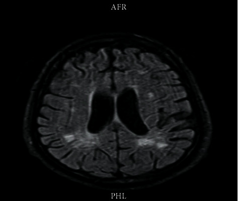 Neuropsychiatric Lupus and Lupus Nephritis Successfully Treated with Combined IVIG and Rituximab: An Alternative to Standard of Care.