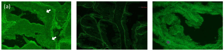 A Case of IgG and IgA Anti-Laminin-332 Antibody-Positive Mucous Membrane Pemphigoid with IgG and IgA Anti-Envoplakin and Anti-Periplakin Antibodies.