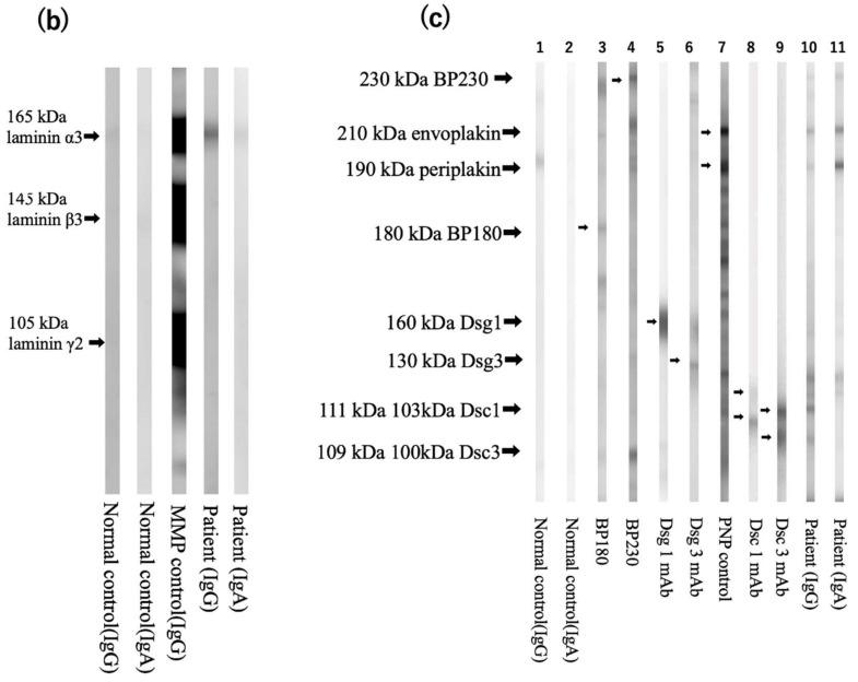 A Case of IgG and IgA Anti-Laminin-332 Antibody-Positive Mucous Membrane Pemphigoid with IgG and IgA Anti-Envoplakin and Anti-Periplakin Antibodies.