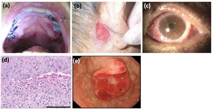 A Case of IgG and IgA Anti-Laminin-332 Antibody-Positive Mucous Membrane Pemphigoid with IgG and IgA Anti-Envoplakin and Anti-Periplakin Antibodies.