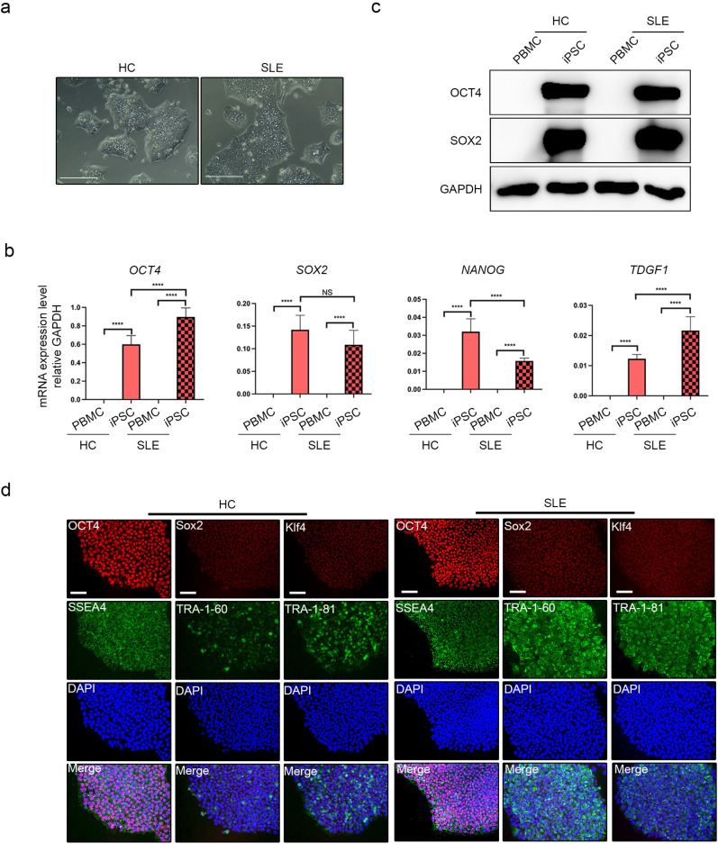 Lupus Heart Disease Modeling with Combination of Induced Pluripotent Stem Cell-Derived Cardiomyocytes and Lupus Patient Serum.