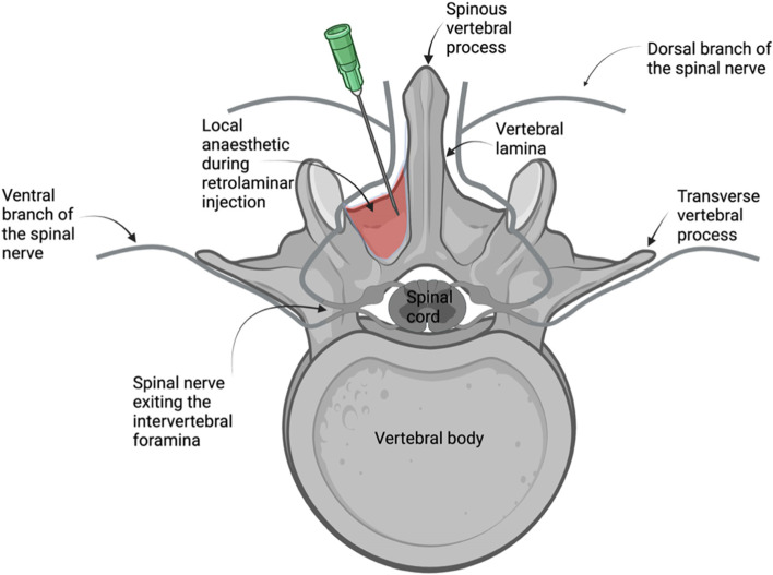 Thoracolumbar retrolaminar block in seven dogs undergoing spinal surgery.