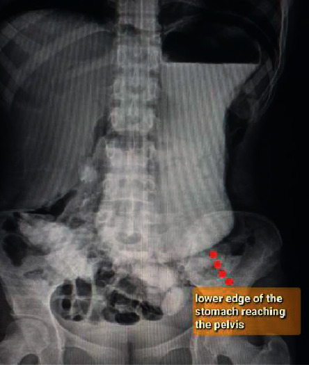 Superior Mesenteric Artery Syndrome Managed with Laparoscopic Duodenojejunostomy.