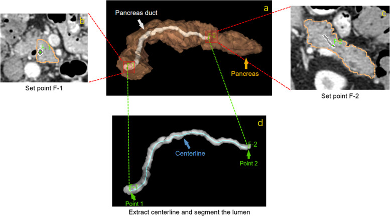 Open-source algorithm and software for computed tomography-based virtual pancreatoscopy and other applications.